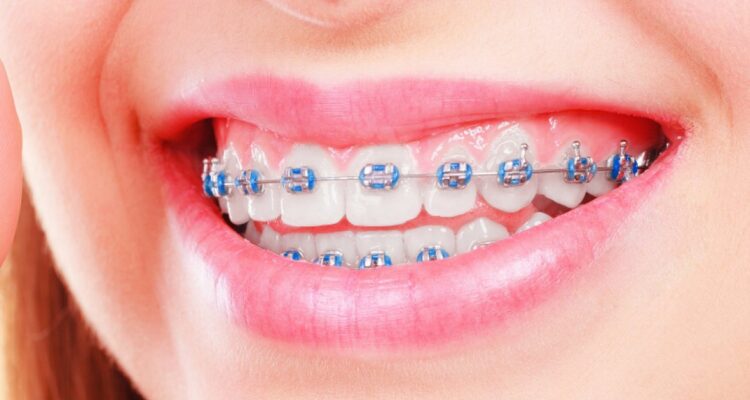 Diş Teli Tedavisi Ne Kadar Sürer