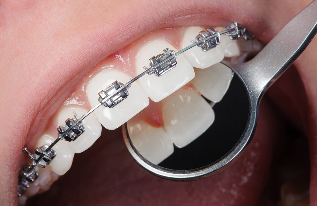 Diş Teli Tedavisi Neden Yapılır