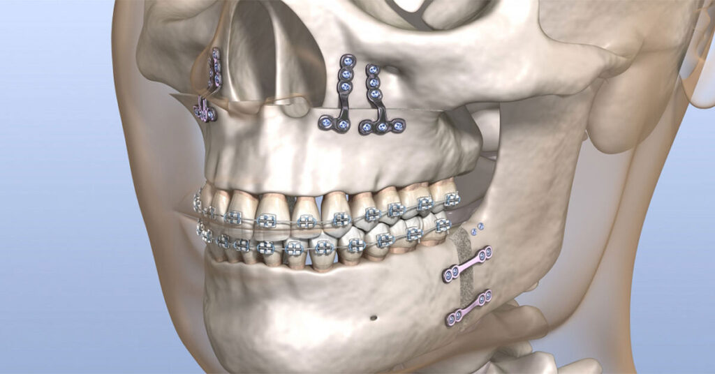 Ortognatik Cerrahi Nasıl Yapılır? Ortognatik Cerrahi Nasıl Yapılır?
